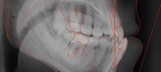 Odontoiatria: Come ho risolto la terza classe scheletrica o morso inverso con linea mediana across….la mia esperienza