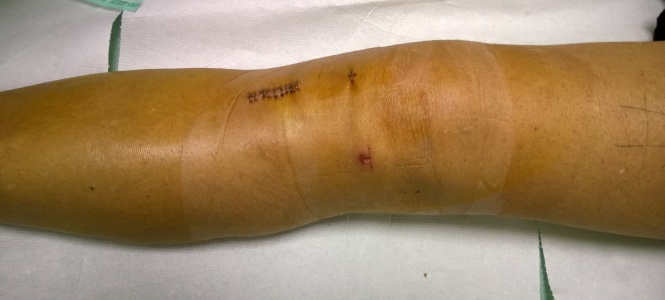 Lesione Del Legamento Crociato Anteriore (LCA) e Operazione Di Ricostruzione: La Mia Esperienza